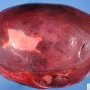 Splenic epidermoid cyst