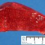 Spleen with white pulp hyperplasia