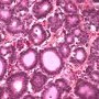 Pancreatic acinar cell carcinoma