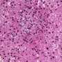 Hepatic granuloma (Etiology unknown)