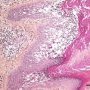 Epidermolytic hyperkeratosis