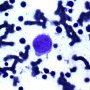 Parvovirus B19 cytopathogenic effect in bone marrow