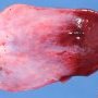 extralobar pulmonary sequestration