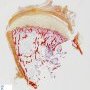 Osteochondroma
