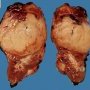 Ruptured WIlms tumor