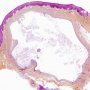Mucocele