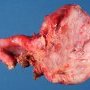 Ovarian luteal cyst