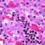 Parvoviral inclusion in fetal liver (hydrops fetalis)