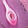 Basaloid pilomatricoma