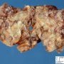 Plexiform neurofibroma in neurofibromatosis type 1 (NF1)