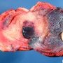 Gravid uterus