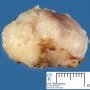 Mammary fibroadenoma