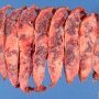 Massive placental fibrosis