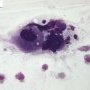 Gaucher cell in bone marrow cytology