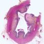 Colonic Crohn disease (Crohn colitis)