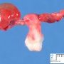 Fetal ovarian cyst (29 weeks)