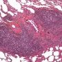Pulmonary nodular lymphoid hyperplasia