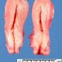 Normal uterus