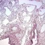 Pleuropulmonary blastoma type 1