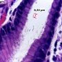 Helicobacter heilmanii gastritis
