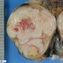 Seminoma of the testis