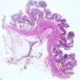 Lymphoid polyposis (multiple lymphoid polyps)