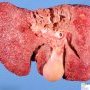 Micronodular cirrhosis in Wilson disease