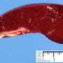 Spleen