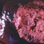 Pulmonary angiosarcoma (Yale Rosen Collection)