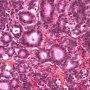 Pancreatic acinar cell carcinoma
