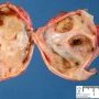Ovarian endometriotic cyst