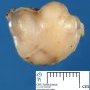 Mammary fibroadenoma