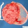 Normal amniotic membrane around the placenta