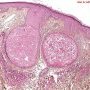 Hidrocystoma