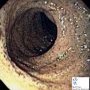 Chylomicron retention disease (Duodenal endoscopy)