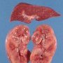 ARPKD at 34 weeks