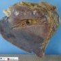 Extralobar pulmonary sequestration