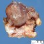 Cyst of the thyroglossal tract