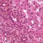 Acute cholangitis