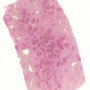 Confluent centrilobular necrosis in hepatic veno-occlusive disease