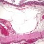 Colonic pneumatosis in cystic fibrosis