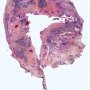 Thymic cyst