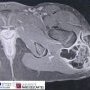 Tumoral calcinosis