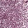 Acute pneumonia in bacterial pneumonia