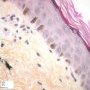 Griscelli syndrome - Skin