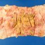 Pseudomembranous colitis in infectious colitis with parietal (...)