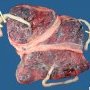 Triple pregnancy placenta
