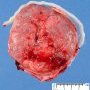 Normal placenta