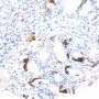 Atypical Adenomatous Hyperplasia - 34bE12 Immunostain