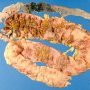 Pseudomembranous colitis in infectious colitis with parietal (...)